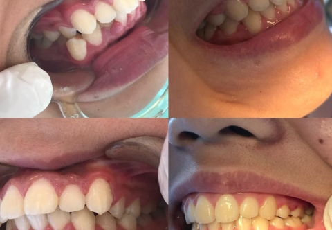 Niềng răng hô mất bao lâu? Chi phí niềng răng hô